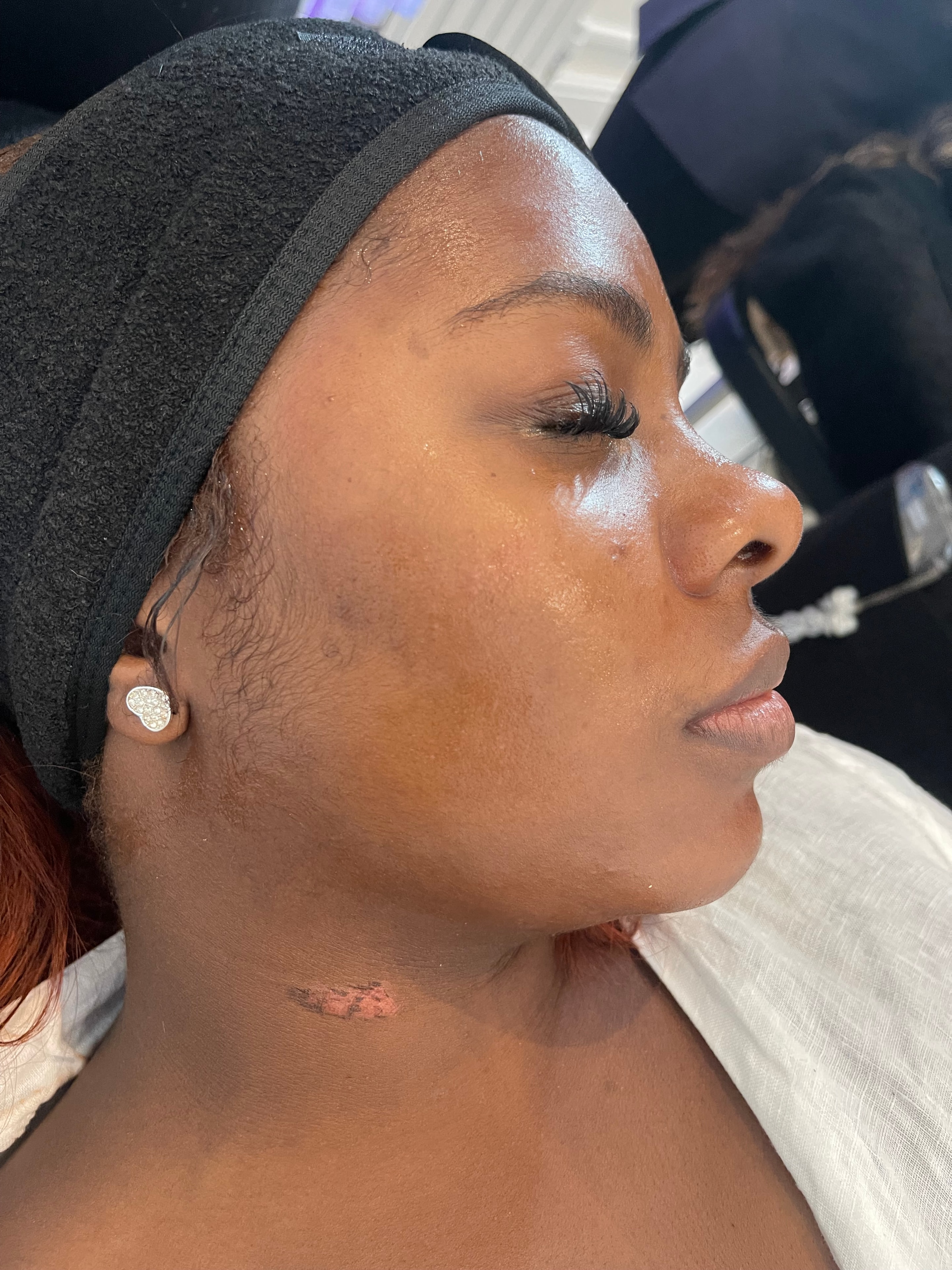 Hydrafacial before and after — glowing skin result after one session — Bury Skin, Laser & Wellness Clinic, Bury