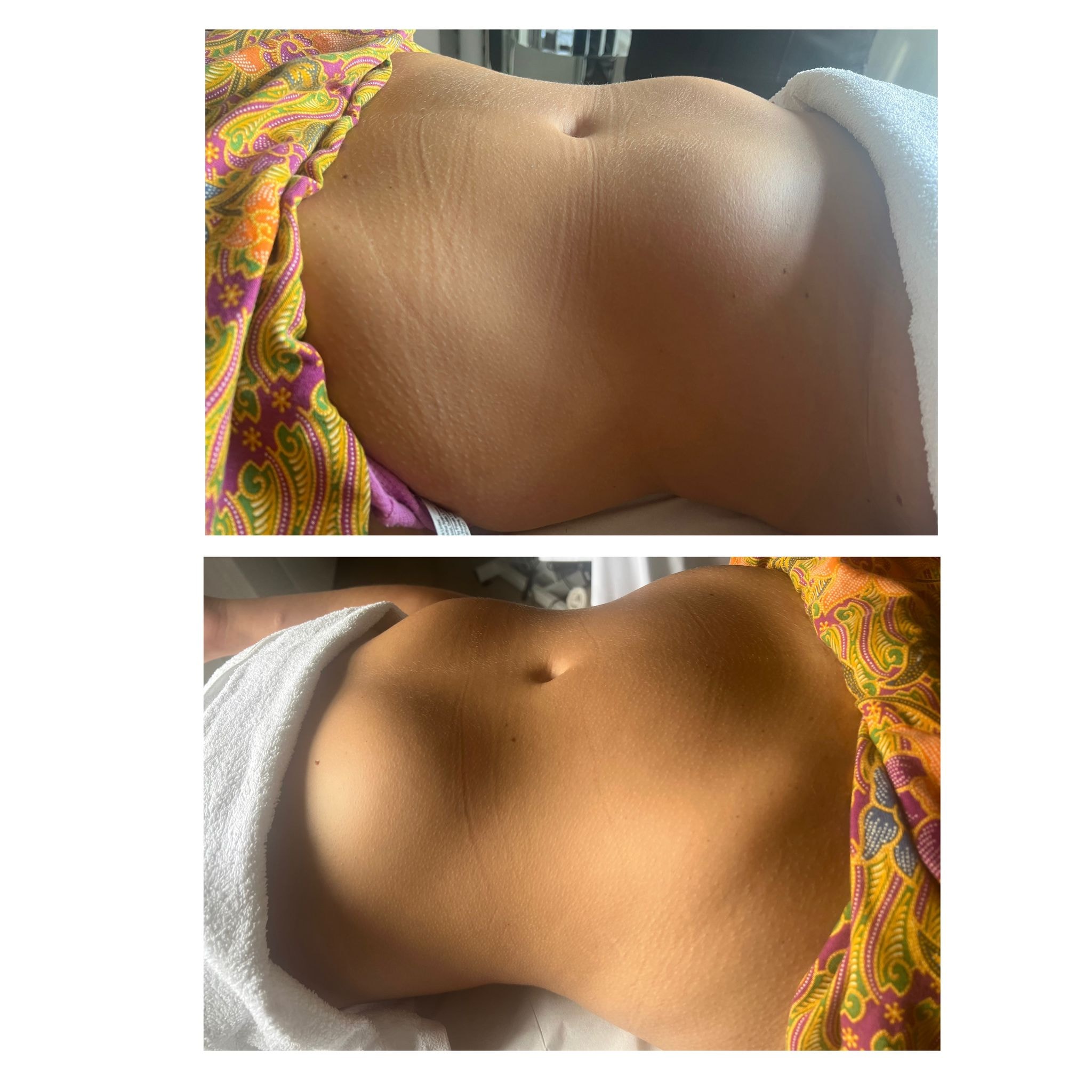 Lymphatic drainage massage before and after — leg contouring and puffiness reduction after 1 session — Bury Skin, Laser & Wellness Clinic, Bury