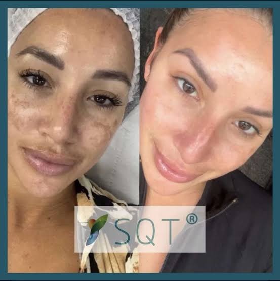 SQT Bio-Microneedling before and after — pigmentation improvement — Bury Skin Clinic
