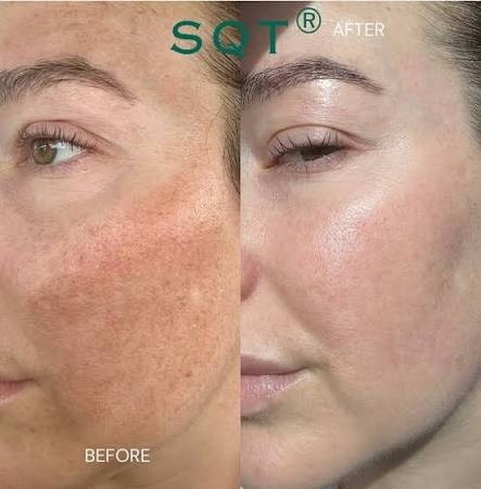 SQT Bio-Microneedling before and after — skin texture and tone improvement — Bury Skin Clinic