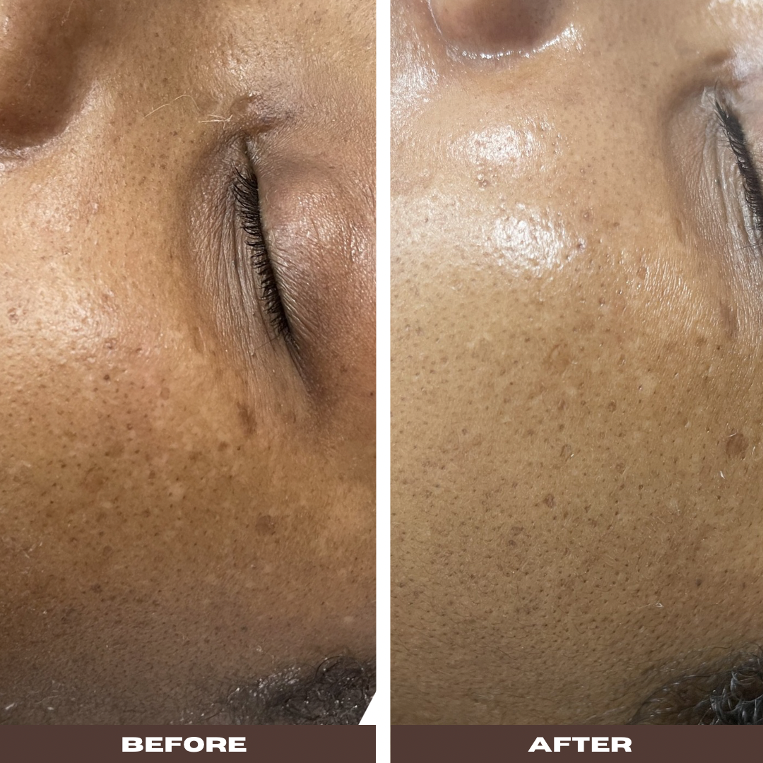 SkinPen microneedling and polynucleotide before and after result after 1 session — Bury Skin, Laser & Wellness Clinic, Bury, Greater Manchester