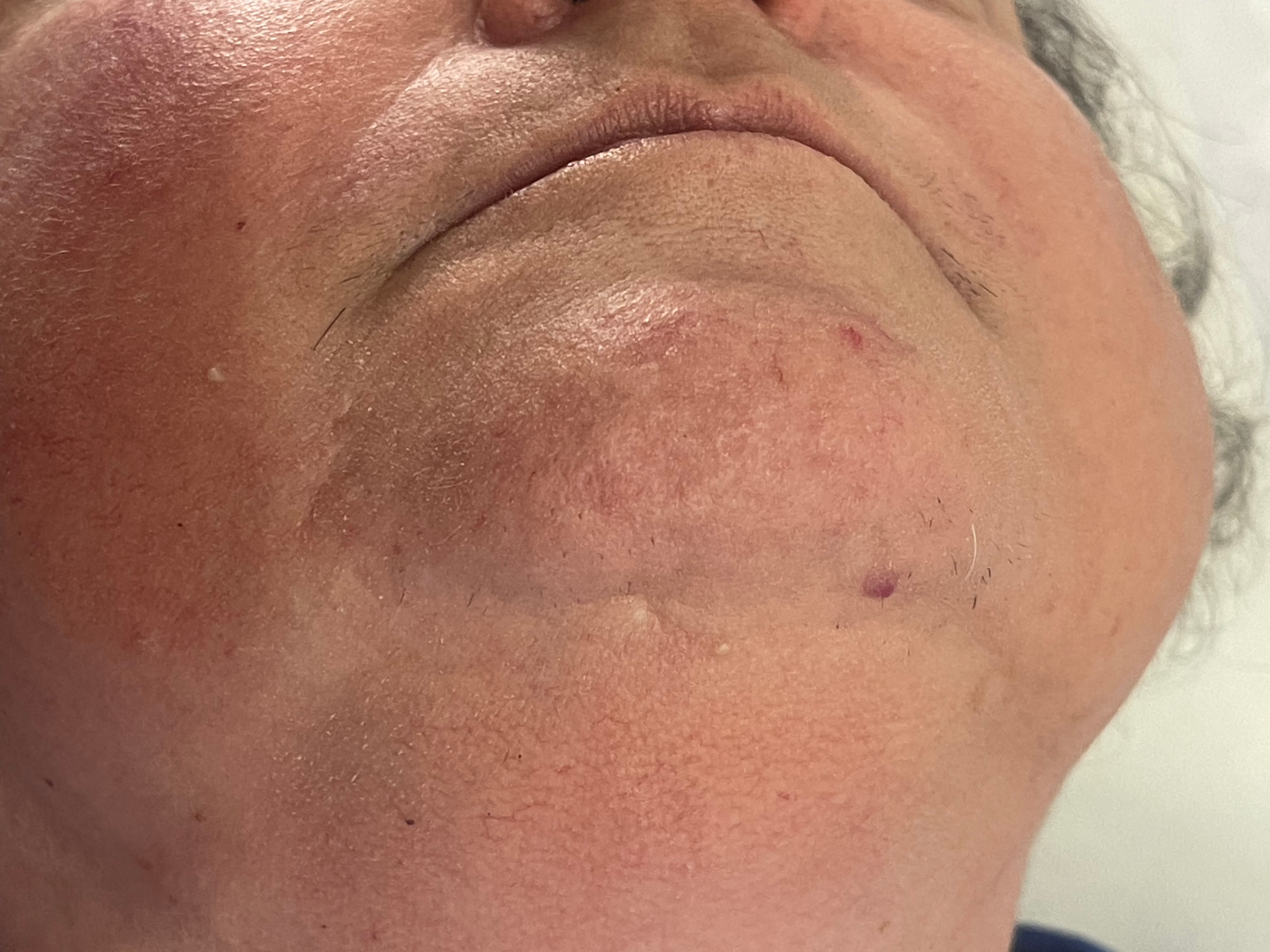 After laser hair removal treatment — chin and jaw area, 1 session — Bury Skin, Laser & Wellness Clinic, Bury, Greater Manchester